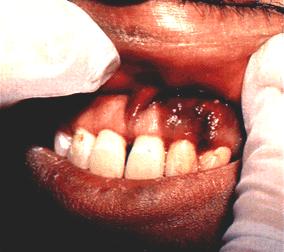 image of Kaposi sarcoma: oral plaque