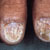 thumbnail image of Psoriasis: nail changes