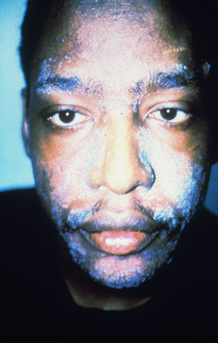image of Seborrheic dermatitis