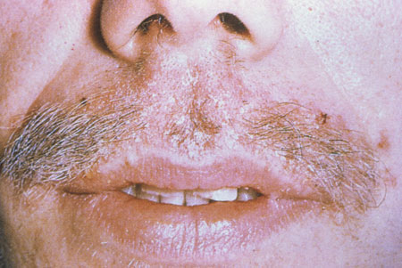 image of Seborrheic dermatitis