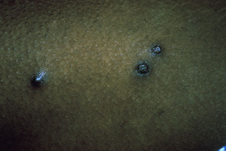 image of Bacillary angiomatosis