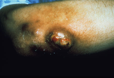image of Bacillary angiomatosis