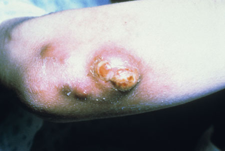 image of Bacillary angiomatosis