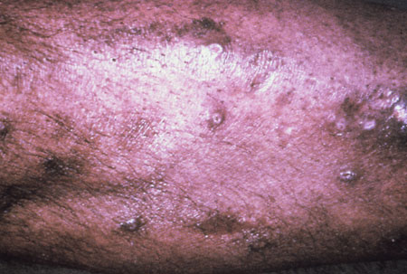 image of Bacillary angiomatosis