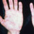 thumbnail image of Secondary syphilis: palmar rash