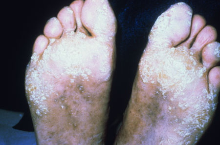 image of Warts