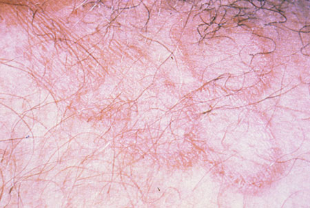 image of  Trichophyton rubrum 