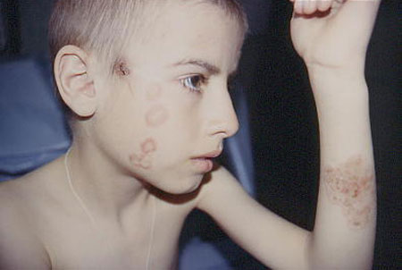 image of Tinea corporis: severe