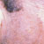 thumbnail image of Dermatophyte: face