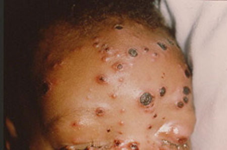 image of  Acanthamoeba
                    infection
                