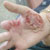 thumbnail image of Herpes simplex: initially mistaken for staphylococcal infection