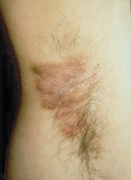 image of Staphylococcal infection: occurring as folliculitis