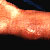 thumbnail image of Bacillary angiomatosis: wrist mass