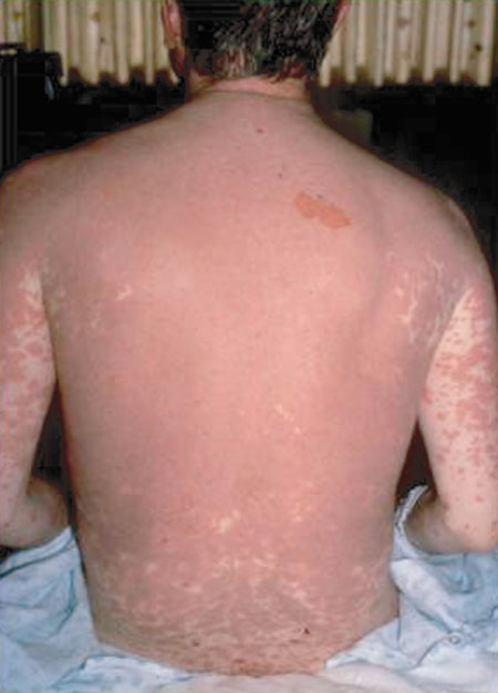 image of Drug reaction: producing full-body erythema