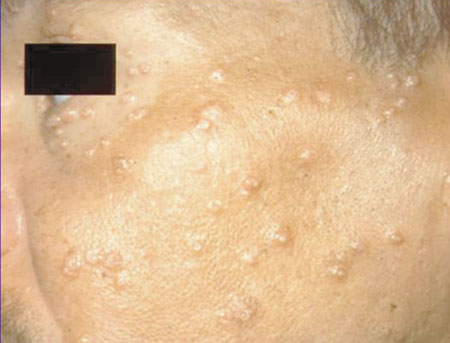 image of Molluscum: facial, severe