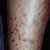 thumbnail image of Lichen planus: associated with HIV and hepatitis C virus coinfection