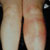 thumbnail image of Erythema nodosum