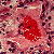 thumbnail image of  Bartonella henselae
                    /Bacillary angiomatosis: cutaneous biopsy
                