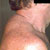 thumbnail image of Lipoaccumulation: dorsocervical fat pad