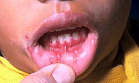 image of Herpes simplex