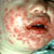 thumbnail image of Herpes simplex
