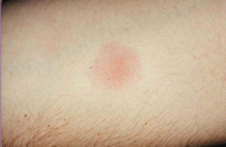 image of Tuberculosis: delayed hypersensitivity skin test