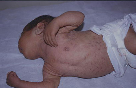 image of Scabies: in an infant with HIV