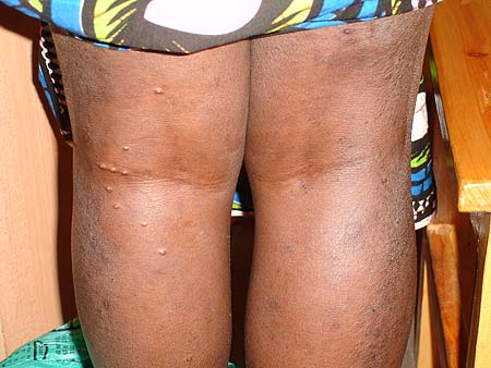 image of Molluscum contagiosum