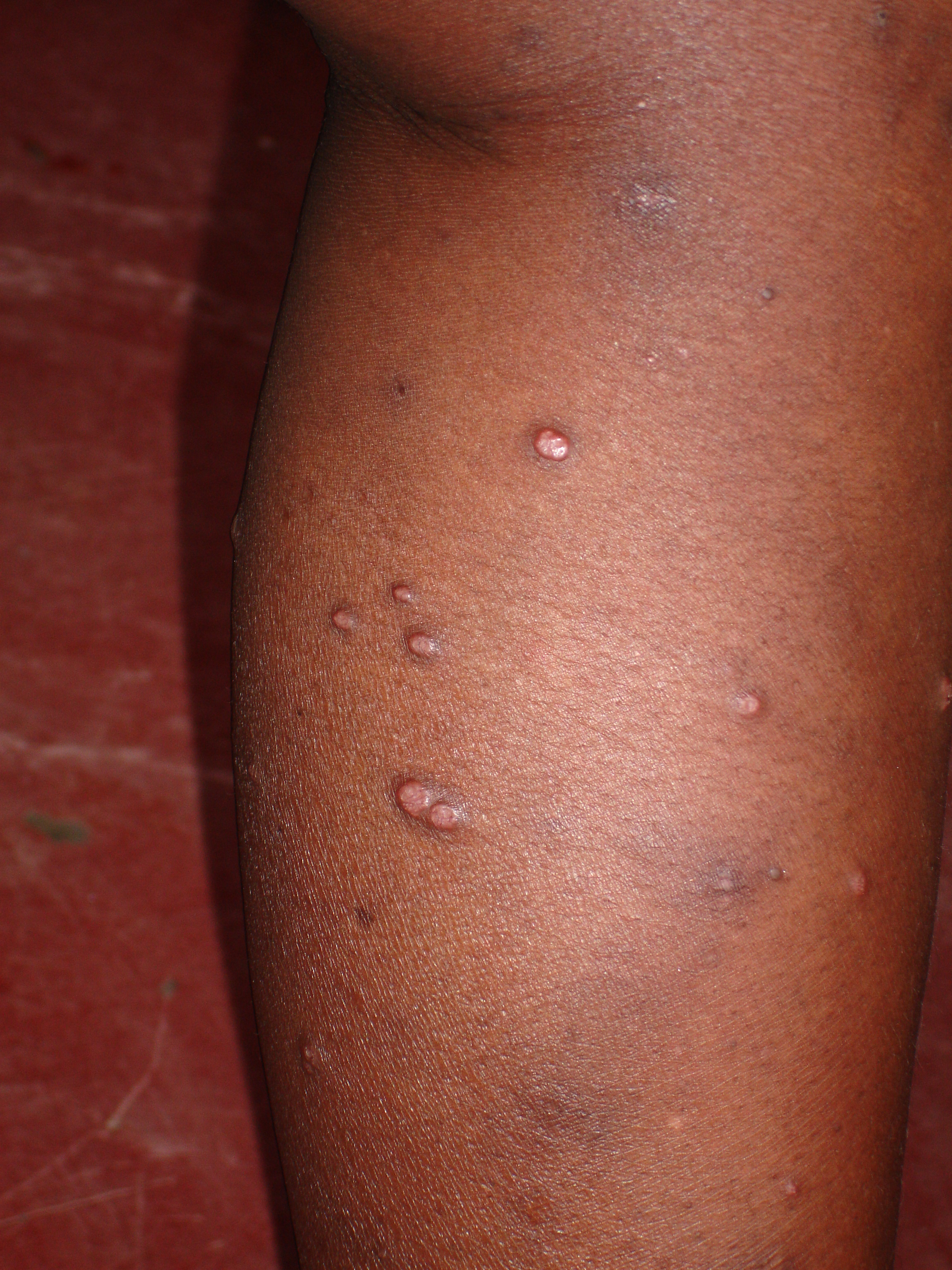 image of Molluscum contagiosum