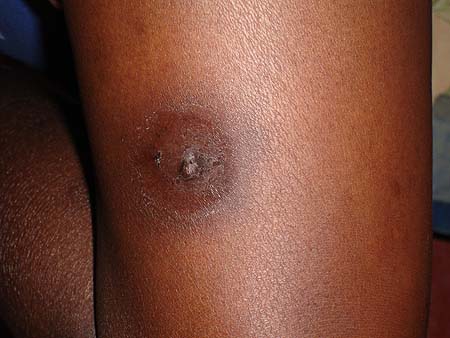 image of Molluscum contagiosum