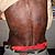 thumbnail image of Cutaneous manifestations on the back of an HIV-infected man