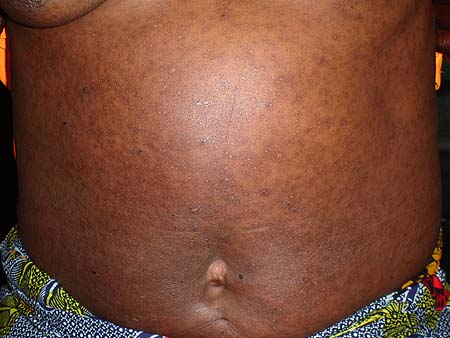 image of Cutaneous manifestations in a woman with HIV