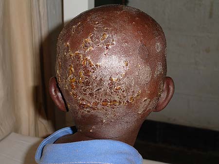 image of Tinea capitis: superinfected