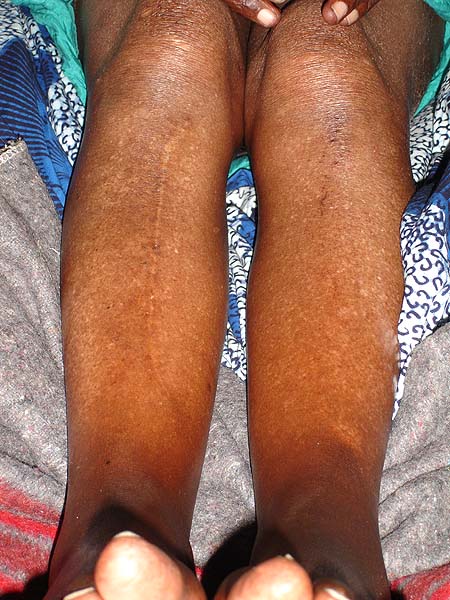 image of Depigmentation (spontaneous): labial, suborbital, abdominal, both legs; arcus senilis
