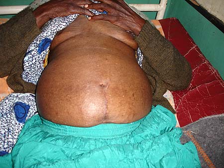 image of Depigmentation (spontaneous): labial, suborbital, abdominal, both legs; arcus senilis