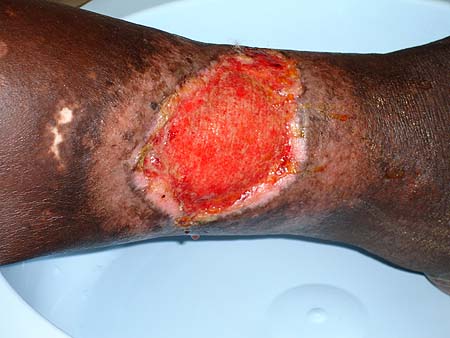 image of Ulcus cruris: debridement