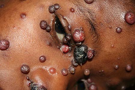image of Bartonella infection (presumptive): nodules of various sizes on the face