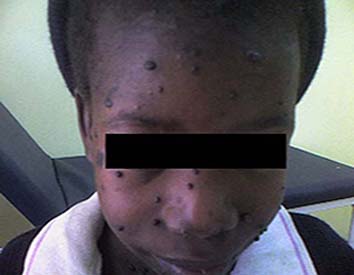 image of Bartonella infection (presumptive): skin lesions on face 4 weeks after treatment