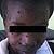 thumbnail image of Bartonella infection (presumptive): skin lesions on face 4 weeks after treatment