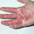 thumbnail image of Candidiasis: cutaneous