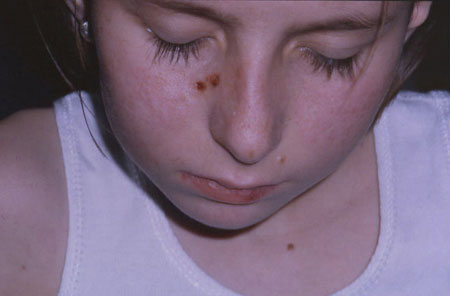 image of  Cryptococcus neoformans
                    infection: cutaneous
                