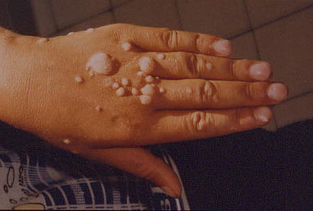 image of Human papillomavirus
