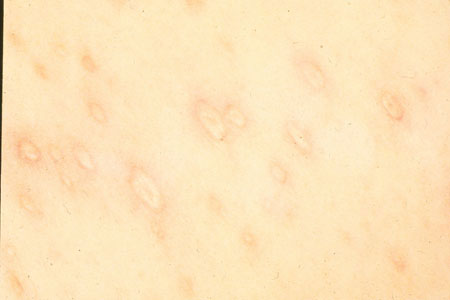 image of Varicella: chickenpox