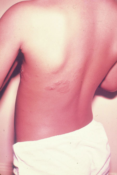 image of Herpes zoster (shingles)