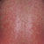 thumbnail image of Drug rash: nonnucleoside reverse transcriptase inhibitor associated