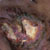 thumbnail image of Non-Hodgkin lymphoma: arising from Kaposi sarcoma