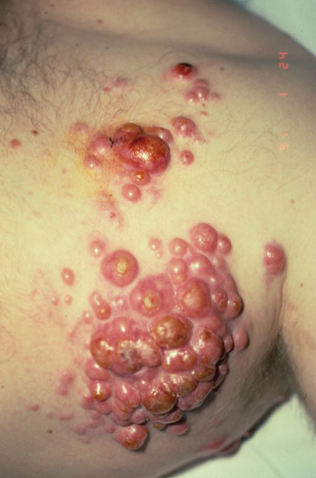 Lymphoma Images - HIV