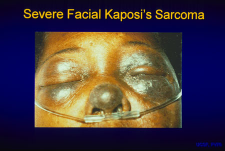 image of Kaposi sarcoma: facial, severe