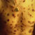 thumbnail image of Kaposi sarcoma: chest