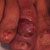 thumbnail image of Kaposi sarcoma: foot